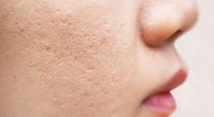 Cicatrizes de acne: como se prevenir e dicas para cuidar