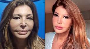 Roberta Close faz cirurgia plástica aos 60 anos e médica alerta: 'Harmonização não apaga o tempo'