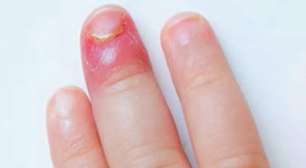 Como tratar um unheiro: cuidados e dicas essenciais