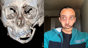 Caso raro no Brasil: jovem se prepara para reconstrução facial com prótese feita em impressora 3D