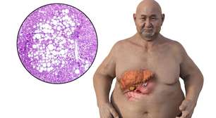 Gordura no fígado: sintomas, riscos e como prevenir a esteatose hepática