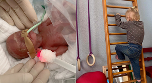 'Um pequeno milagre': bebê prematuro nasce com 300 gramas e sobrevive