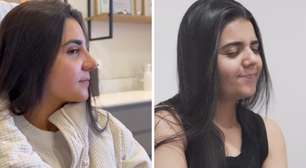 Yasmin Santos se choca com resultado de rinoplastia: 'Ainda está bem inchado'