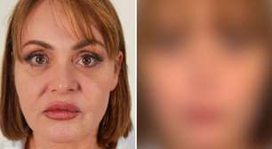 Outra pessoa! Gaby Spanic faz harmonização facial e quase não é reconhecida; veja
