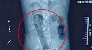 Empresário busca atendimento após desodorante ficar preso no ânus em Rondônia