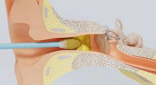 Veja os prós e contras e o perigo do uso de cotonete no ouvido