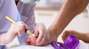 Fungo na unha? Como tratar. E veja cuidados para evitá-los