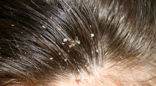 Quais as causas da caspa e como cuidar deste problema?