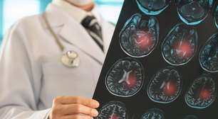 Como as células-tronco podem ajudar na recuperação do cérebro após um derrame