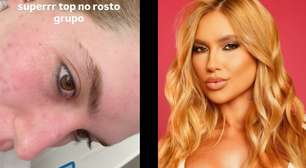 Virginia faz tratamento com laser para tratar marcas de acne no rosto