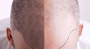 Porque o Brasil está se tornando um centro para transplante capilar masculino?