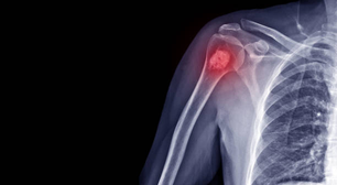 Medicamento pode aumentar as taxas de sobrevivência de crianças com câncer ósseo raro