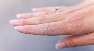 4 componentes que vão te ajudar a prevenir mãos ressecadas
