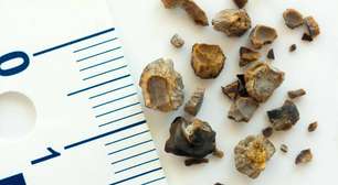 Pedras nos rins: causas, sintomas e como prevenir o desconforto