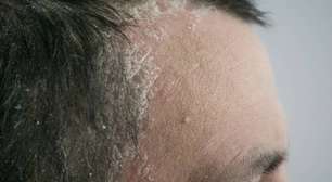 Seborreia: como lidar com a oleosidade excessiva e melhorar a saúde da sua pele