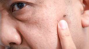 Tudo sobre verrugas escuras na pele: quando se preocupar e como tratar