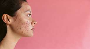 O verão está chegando! Veja como cuidar da acne na estação
