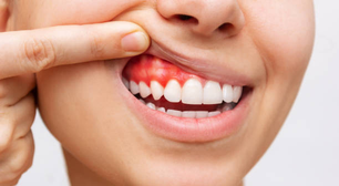 Doença gengival pode aumentar risco de AVC e danos cerebrais