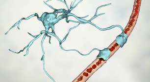 Doença de Huntington: como as terapias genéticas estão mudando o futuro da condição