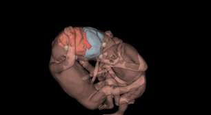 Imagens que salvam: IA e ultrassom 3D revolucionam medicina fetal e são decisivas para gêmeos siameses