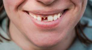 O Japão está cada vez mais perto de realizar o sonho dos dentistas: um medicamento para fazer crescer novos dentes