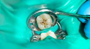 Dente com amálgama? Saiba quando trocar e quando ele está seguro