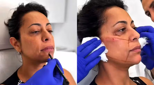 UAU! Samantha Schmütz faz procedimento no rosto com mesmo médico das Kardashians