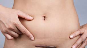 Por que algumas cicatrizes viram queloides?