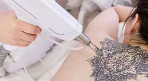 Remoção de tatuagens em alta: Conheça 4 tratamentos populares