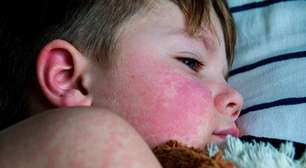 O que é quais os sintomas, causas e tratamento da rubéola?