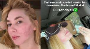 Virginia abre o jogo sobre procedimento que deixou a pele do rosto irritada: 'Tinha necessidade?'