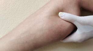 Calor piora o lipedema? Verão aumenta dor e inchaço