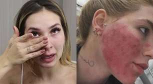 Virginia assusta fãs ao surgir com rosto em carne viva: 'Vai ficar assim agora'