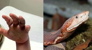 Funcionários de creche confundem picada de cobra com farpa e demoram a socorrer menino