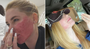 Virginia questiona decisão de fazer procedimento que deixou rosto 'em carne viva': "Tinha necessidade?"