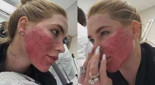 Virginia tranquiliza fãs após aparecer com rosto 'em carne viva' por procedimento estético