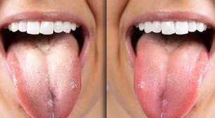 Língua esbranquiçada: descubra os motivos e como cuidar da sua saúde bucal