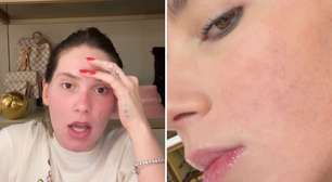 Permanente? Virginia mostra como está rosto queimado após procedimento: 'Pior':