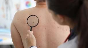 Câncer de pele: exames modernos ajudam no diagnóstico precoce