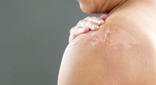 Pele descascando: veja dicas para evitar queimaduras de sol