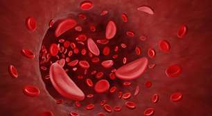 Anemia falciforme no Brasil: tratamento ainda é desafio