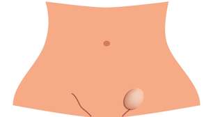 Hérnia inguinal: o problema de saúde que afeta Bolsonaro e exige cirurgia