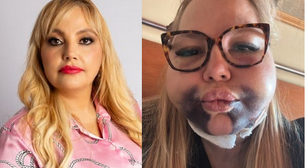 Dentista é denunciada por lesão corporal grave após erro em procedimento estético: 'Minha família foi chamada para se despedir'