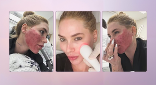 Virginia Fonseca mostra rosto após tratamento intensivo