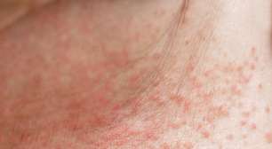 Câncer de pele: como identificar sinais suspeitos