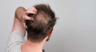 Cientistas alemães usam cafeína ativa em shampoo diário para combater a queda capilar hereditária