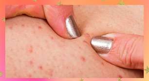 Tudo o que você precisa saber para evitar pelos encravados