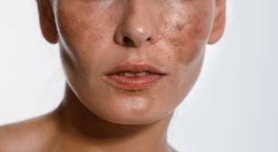 Manchas na pele: um dos maiores desafios dermatológicos