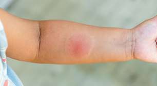 O que fazer em caso de picada de aranha em crianças?