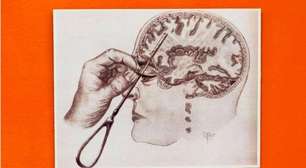 Lobotomia, o polêmico procedimento no cérebro que era considerado 'mais fácil do que tratar uma dor de dente'